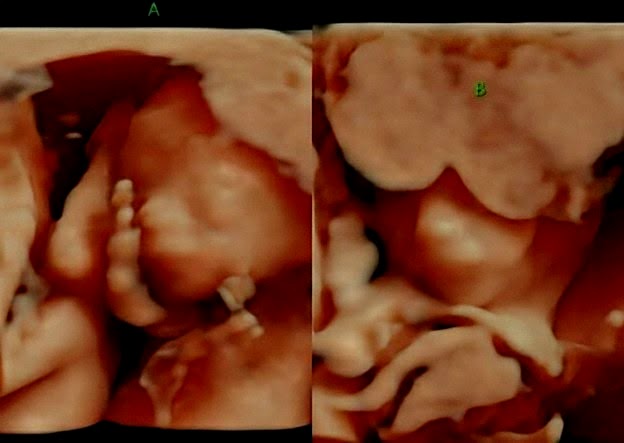 Mansfield Couple Could Use Community Support During Complicated Pregnancy with Twins